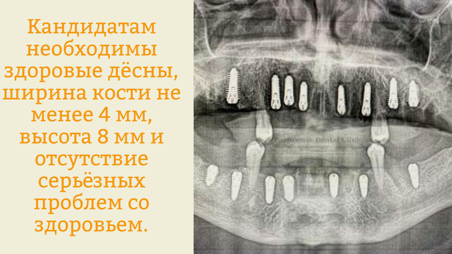 Кто является подходящим кандидатом для All-on-8? Кто является подходящим кандидатом для All-on-8?